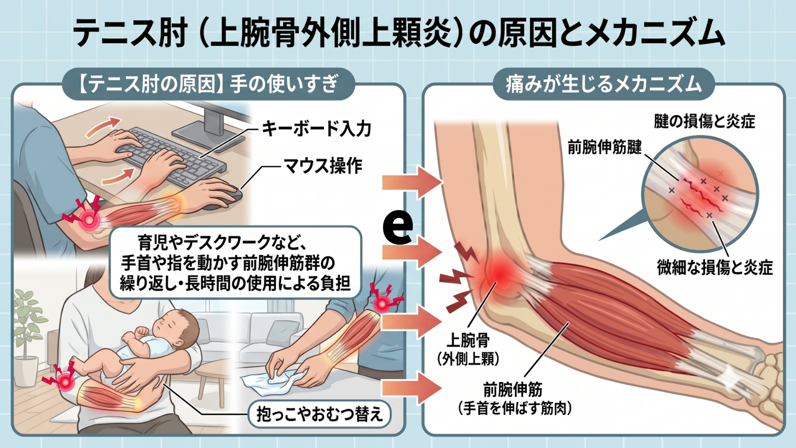 岩倉市と一宮市の間で営業ているいわくら肩甲骨骨盤整骨院のテニス肘・外側上顆炎の説明画像。