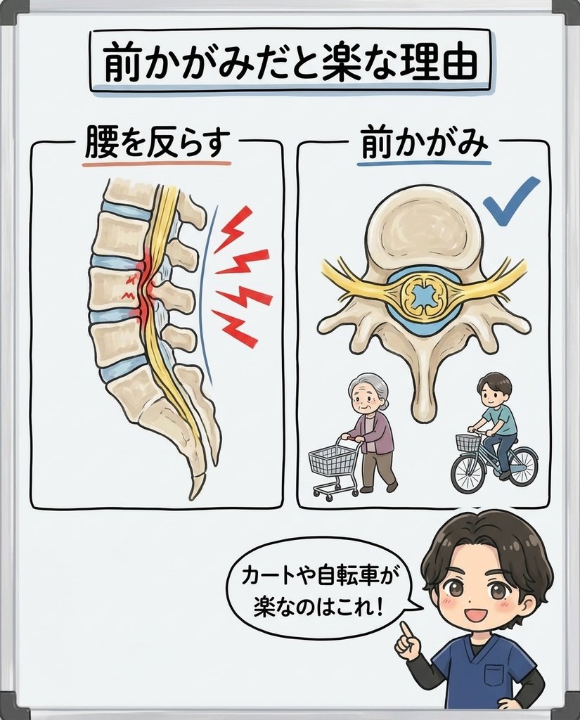 岩倉市・一宮市のいわくら肩甲骨骨盤接骨院による前かがみで脊柱管が広がり楽になる理由の図解イラスト