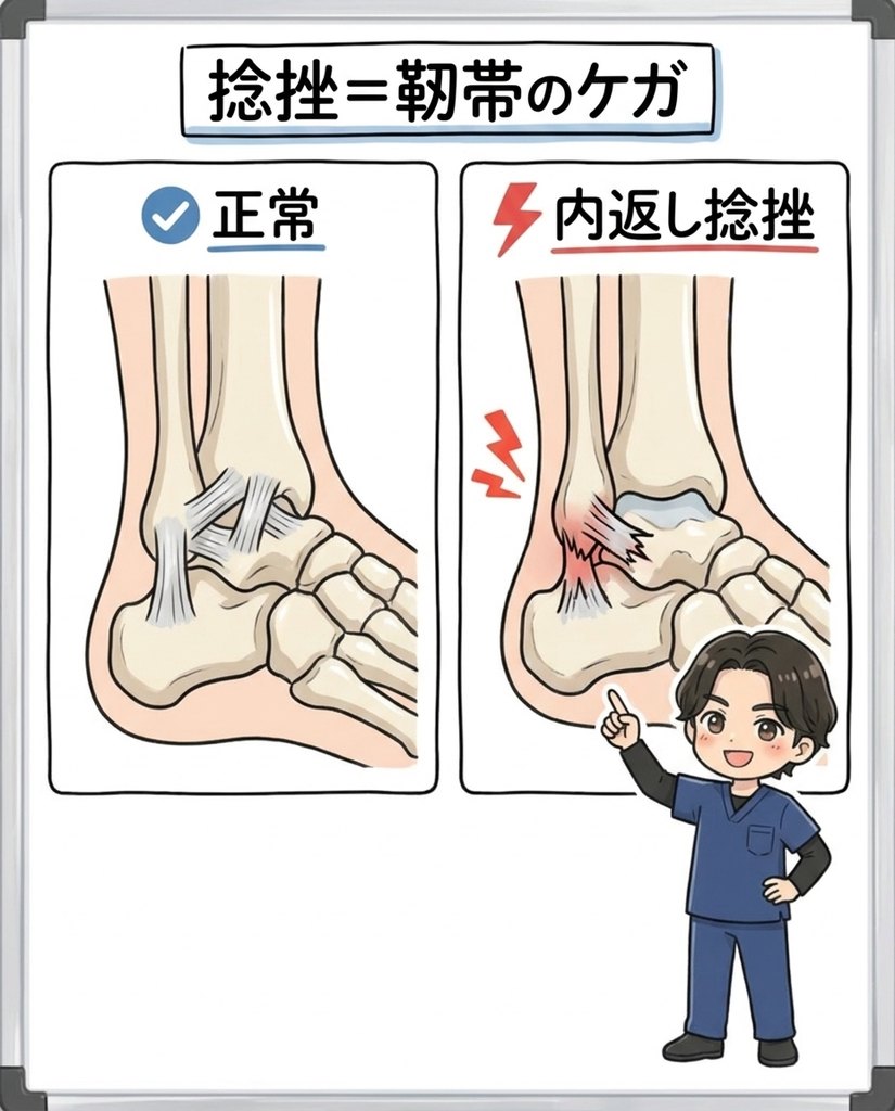 岩倉市・一宮市のいわくら肩甲骨骨盤接骨院による足首の内返し捻挫で外側の靭帯が損傷する図解イラスト