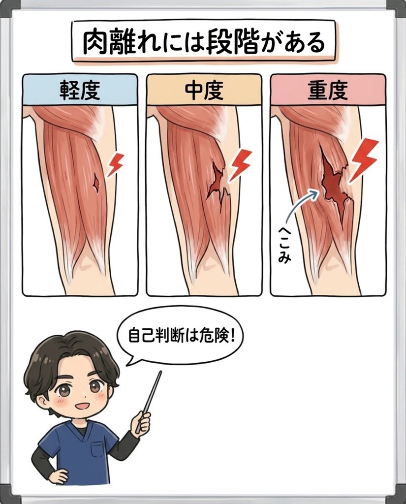 岩倉市・一宮市のいわくら肩甲骨骨盤接骨院による肉離れの重症度3段階の図解イラスト