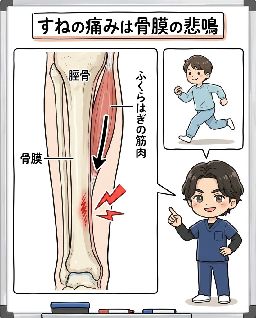 岩倉市・一宮市のいわくら肩甲骨骨盤接骨院によるシンスプリントはすねの骨膜が筋肉に引っ張られて起こるという図解イラスト