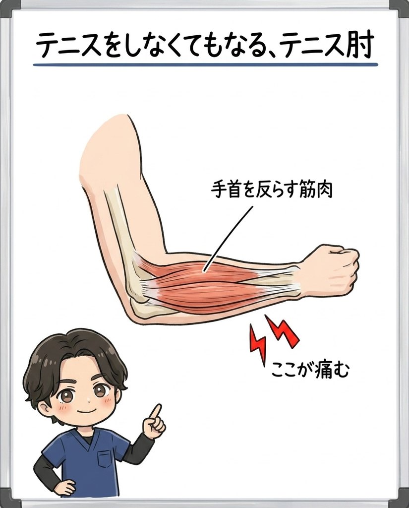 岩倉市・一宮市のいわくら肩甲骨骨盤接骨院によるテニス肘は手首を反らす筋肉の付け根(肘の外側)が痛むという図解イラスト