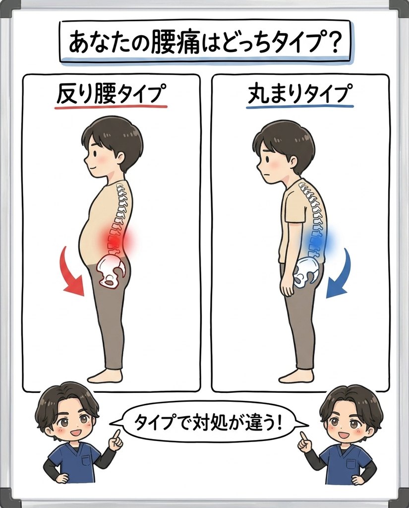 反り腰タイプと丸まりタイプの腰痛の違いの図